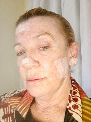 Biopsy Day - 7 x Sites Face