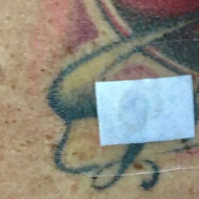 Biopsy Day - Right Shoulder - Mole Removal