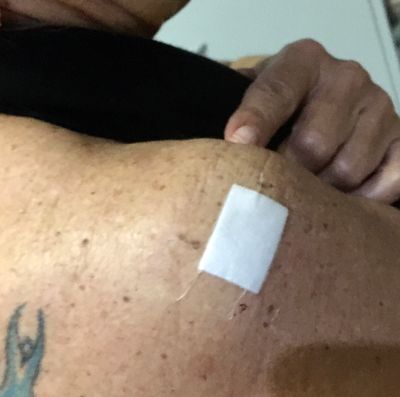 Biopsy Day - Right Shoulder x 1