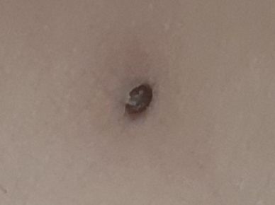 Black dot + red circle on inner thigh? Something t - Cancer