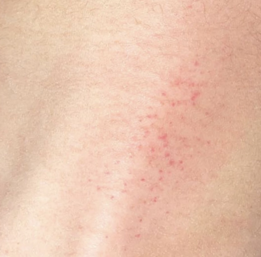Unsure about my symptoms and if they could indicat... - Cancer Council ...