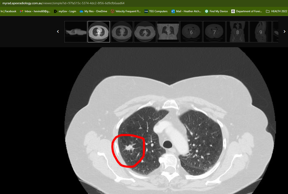 lung with nodule.png