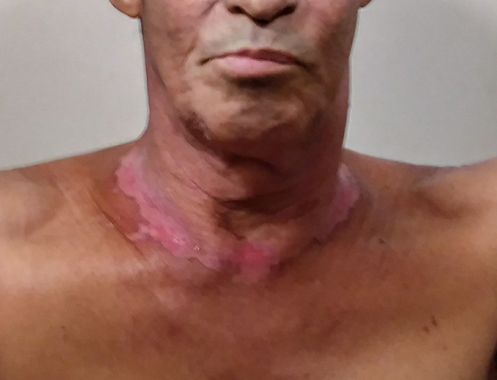 About 13 days after 1st pic.  Almost healed